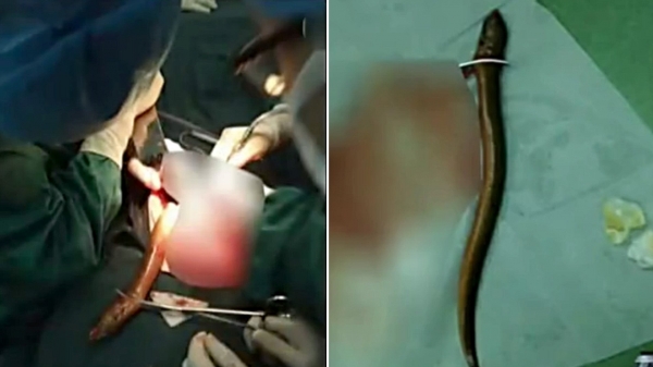 Suýt mất mạng vì nhét con lươn vào hậu môn để chữa táo bón