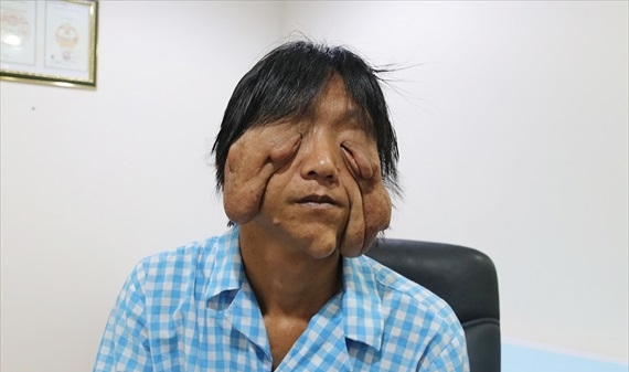 Người đàn ông 17 năm mang khuôn mặt bị biến dạng