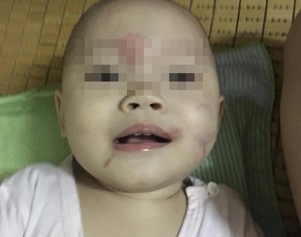 Hải Phòng: Công an làm rõ vụ bé 14 tháng tuổi bị thâm tím mặt sau khi đến lớp
