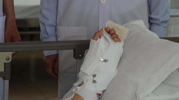 Phẫu thuật nối thành công cánh tay bị chém đứt lìa cho 1 phụ nữ