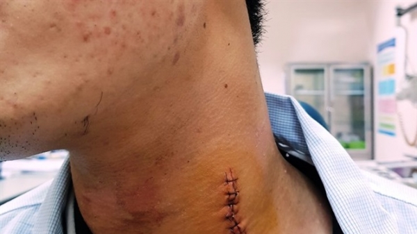 Hơn 1 giờ phẫu thuật gắp mảnh kim loại găm vào cổ nam thanh niên