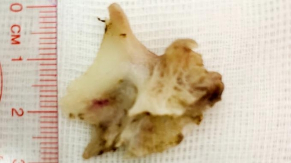 Hóc xương cá 'khủng', một bệnh nhân được can thiệp kịp thời