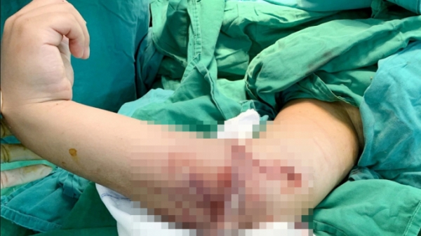 Nối cẳng tay bị đứt lìa bằng kỹ thuật vi phẫu cho trẻ 8 tuổi