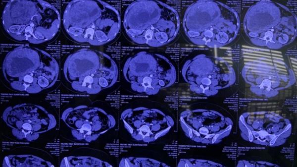 Cắt bỏ khối u đầu tụy to nhất ở Việt Nam từ trước đến nay