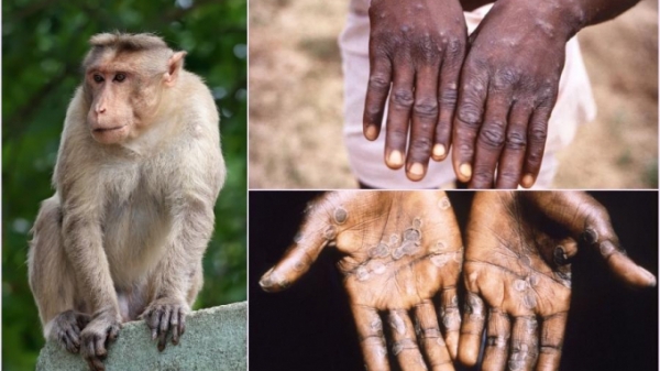 Ca nghi mắc bệnh đậu mùa khỉ đầu tiên tại TP.HCM