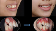 Răng chen chúc, cằm lùi ở trẻ: Phát hiện sớm, can thiệp đúng lúc