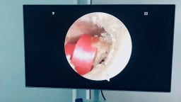 Bé 6 tuổi suýt thủng màng nhĩ vì... một dây buộc tóc cao su