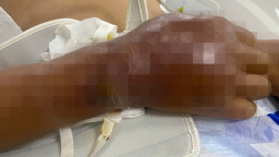 Bệnh nhân uốn ván suy đa cơ quan được cứu sống ngoạn mục