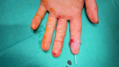 Nối thành công đốt ngón tay bị đứt rời cho nam công nhân
