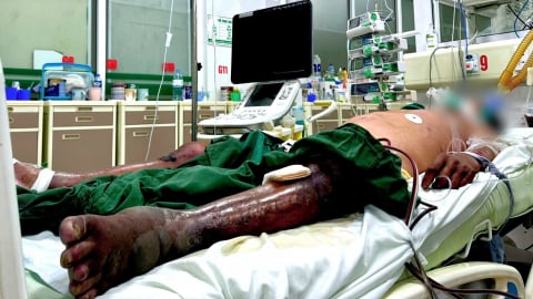 Lội đầm tôm bị gai đâm, người đàn ông nguy kịch do viêm mô bào