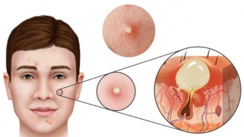 Mụn trứng cá trực tiếp cảnh báo điều gì cho thể trạng?