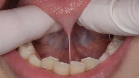 Chăm sóc trẻ sau phẫu thuật cắt phanh lưỡi ngắn đúng cách