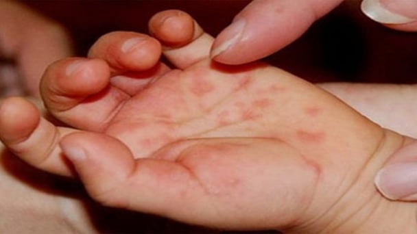 Bệnh tay chân miệng - Hiểu đúng để chăm sóc và điều trị