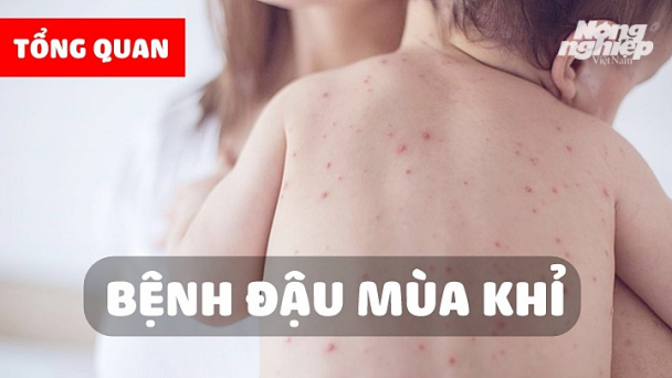 Bệnh đậu mùa khỉ là gì? Dấu hiệu và cách phòng tránh