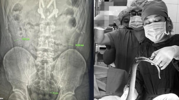 Người đàn ông nhét lươn dài 65cm vào hậu môn bị lươn cắn thủng ruột