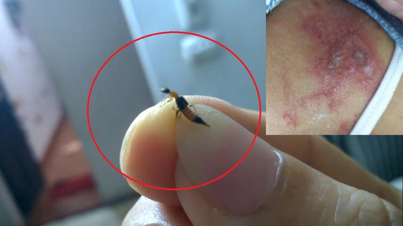 Viêm da tiếp xúc do kiến ba khoang