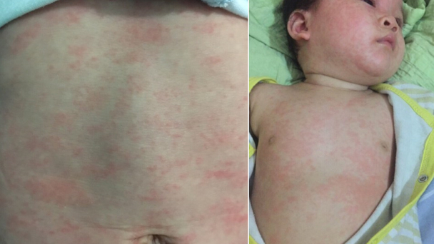 Bệnh sởi gia tăng: Chủ động phòng ngừa để bảo vệ sức khỏe cộng đồng