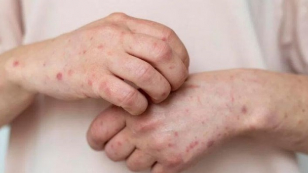 WHO giữ nguyên mức cảnh báo cao nhất về bệnh đậu mùa khỉ