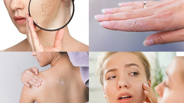 Tổng hợp mẹo chăm sóc da không khô nứt nẻ vào mùa đông