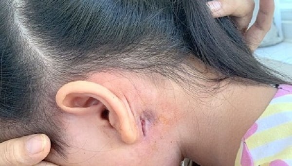 Phát hiện ca vi khuẩn “ăn thịt người” Whitmore thứ 2