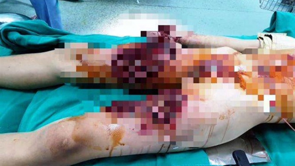 Bắt chước chế thuốc làm pháo trên mạng, một học sinh bị thương nặng