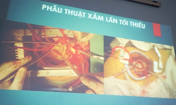 Sử dụng kỹ thuật mới cho bệnh nhân mổ van tim lần 2