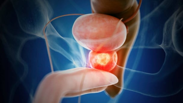Phì đại tiền liệt tuyến ở quý ông có đáng sợ?