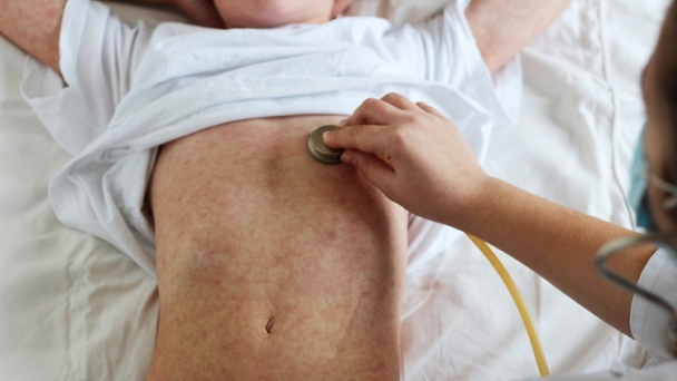 TP.HCM:  Hơn 200 ca mắc sởi trong 1 tuần, số ca bệnh tiếp tục tăng
