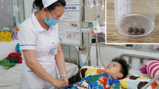 3 viên bi nam châm nằm gọn trong dạ dày bé trai