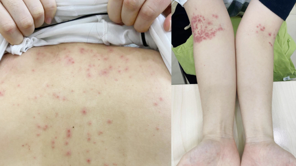 Hi hữu: Mẹ lây bệnh tay chân miệng từ con