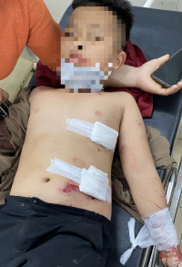 1 trong 4 em nhỏ phải nhập viện   cấp cứu do nghịch pháo.   Ảnh: Thanh Yến.