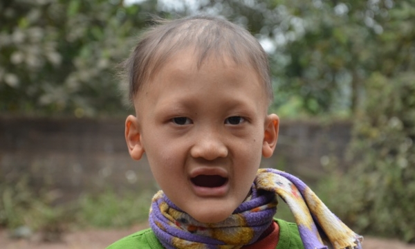 Cậu bé mồ côi mắc bệnh lạ, 7 tuổi vẫn không mọc răng