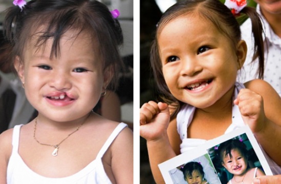 Caritas Sài Gòn tổ chức chương trình mổ sứt môi, hở hàm ếch cho trẻ em nghèo