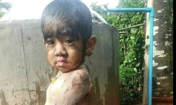 Bé trai 13 tháng tuổi người đầy lông lá vì căn bệnh hiếm gặp