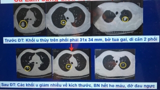 Thông tin y tế sức khỏe mới nhất ngày 21/8: Kem trắng da, trị mụn Bảo Lâm chứa corticoid bị thu hồi