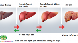 Cảnh báo nguy cơ bị gan nhiễm mỡ cao đối với những trẻ bị thừa cân, béo phì