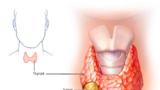 Khó nuốt, coi chừng ung thư tuyến giáp