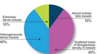 Mật độ nhu mô tuyến vú có liên quan đến ung thư vú hay không?