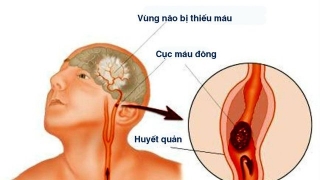 4 đặc điểm trên khuôn mặt có nguy cơ bị nhồi máu não bạn nên để ý kỹ