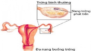 Trị bệnh đa nang buồng trứng bằng những bài thuốc đông y