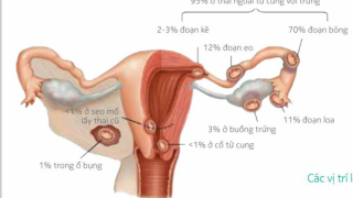 Phụ nữ sinh mổ nên cẩn trong 'thai bám sẹo mổ' khi mang thai lần tiếp theo