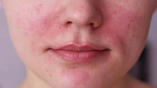 Bệnh Rosacea là gì? Làm thế nào để trị bệnh Rosacea tại nhà?