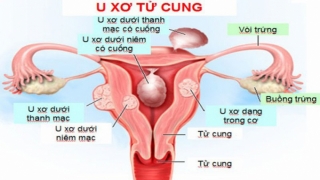 Bị u xơ tử cung có được uống sữa đậu nành không?