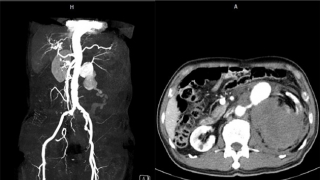 Lần đầu tiên tại Việt Nam: Cứu sống bệnh nhân bị vỡ phình động mạch thận trái