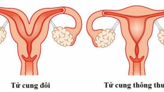 Người phụ nữ mang thai mới biết có hai tử cung