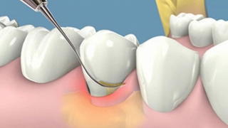 Cao răng là gì? Tác hại của cao rằng