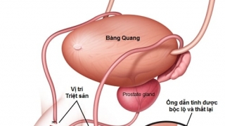 Phẫu thuật thắt ống dẫn tinh có thể gây ra những tác dụng phụ gì?