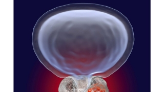 Liệu pháp dùng hormone điều trị ung thư tuyến tiền liệt có thể làm gia tăng nguy cơ tim mạch ở người bệnh