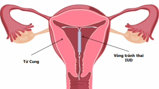 Bao lâu sau đặt vòng thì được quan hệ?