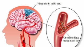 Cần cảnh giác với cơn thiếu máu não thoáng qua